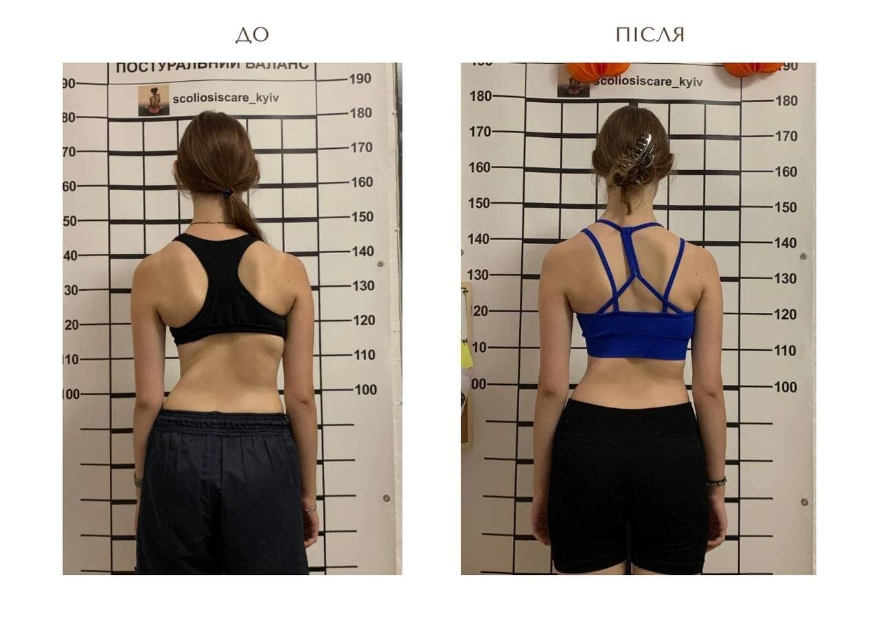 Schroth Therapy Result 10