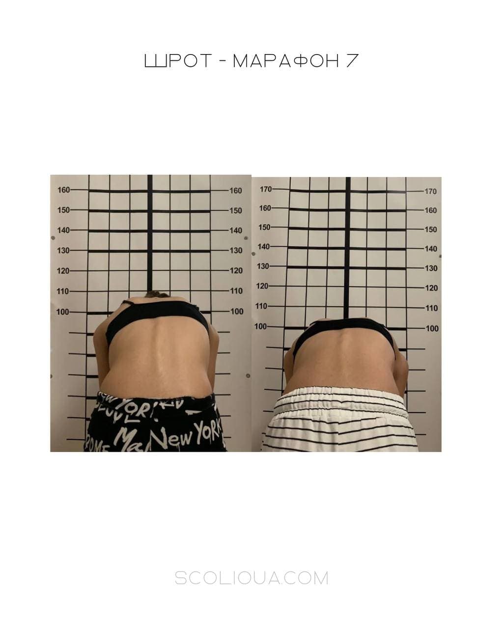 Schroth Therapy Result 2