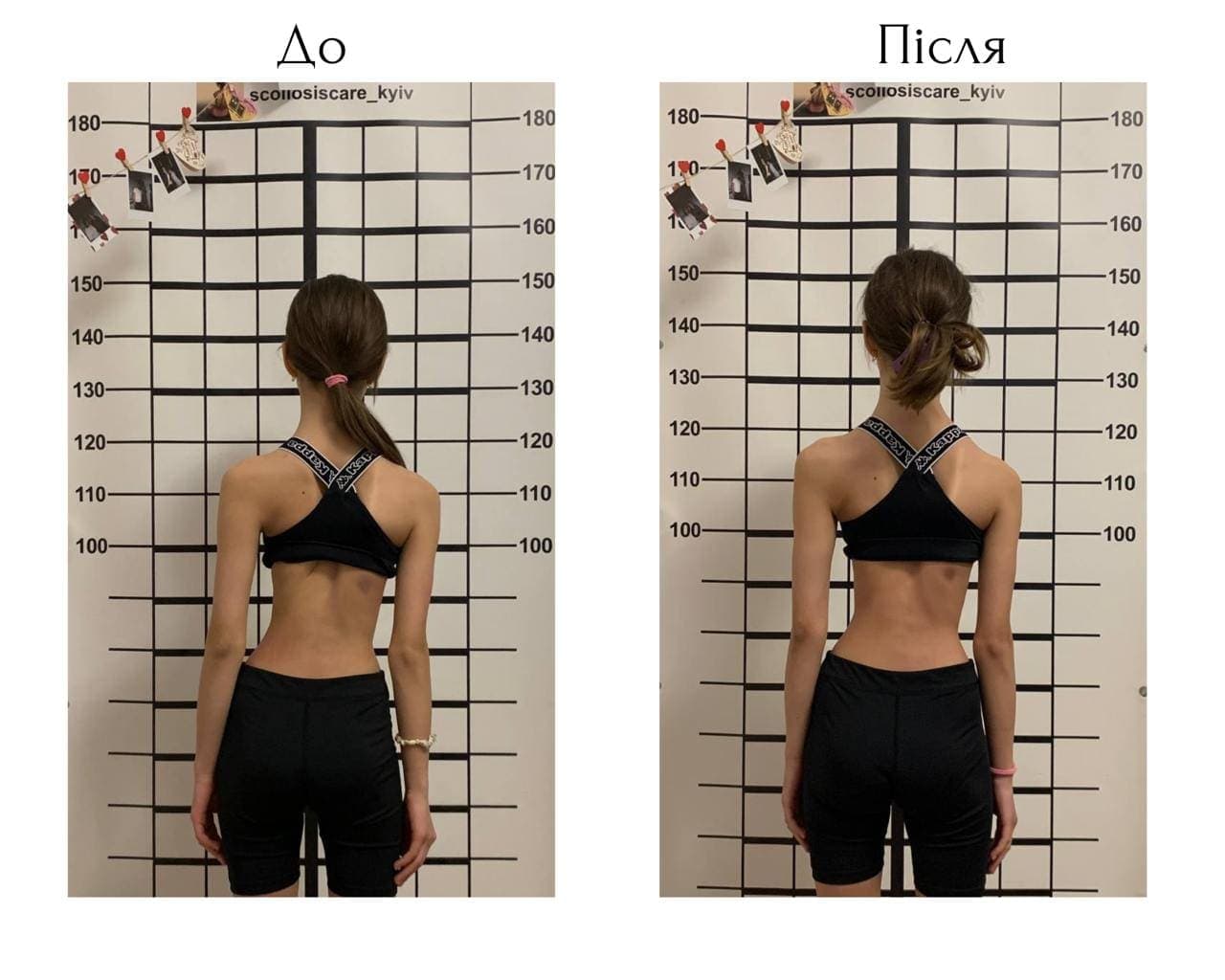 Schroth Therapy Result 6